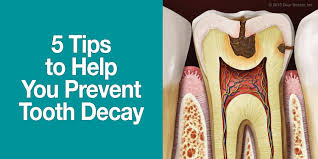 How to Prevent Dental Caries