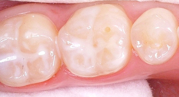 Fissure Sealants