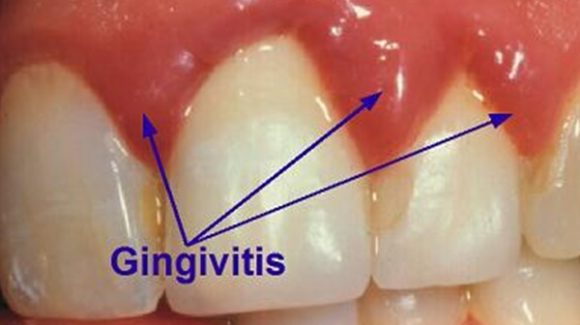 What is Gingivitis?