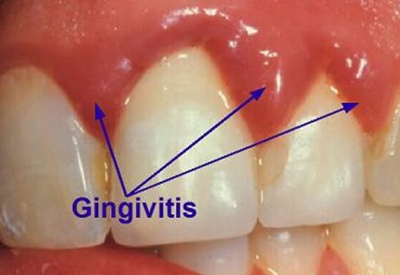 What is Gingivitis?