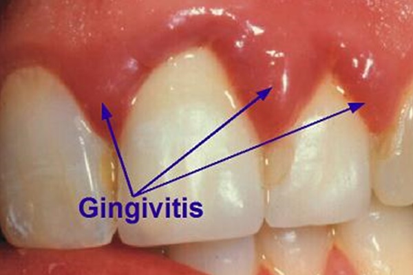 What is Gingivitis?