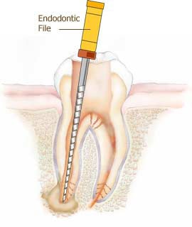 Root Canal Options